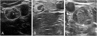 Application and Research Progress of High Frequency Ultrasound in the Diagnosis of Chronic Inflammatory Neuropathies